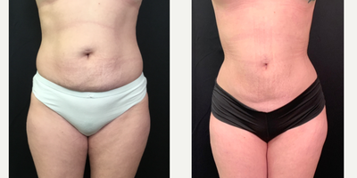 Liposuction before and after photo