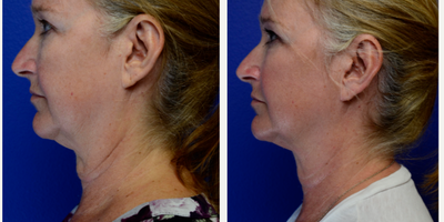 Nonsurgical Facelift before and after photo