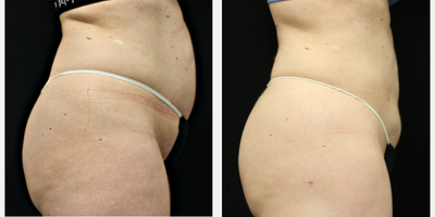 BodyTite before and after photo