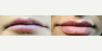 Lip Fillers before and after photo