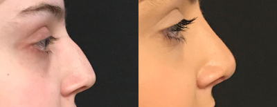 Rhinoplasty before and after photo