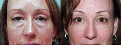 Botox before and after photo