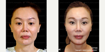 Facelift before and after photo