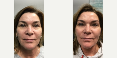 Halo Laser before and after photo