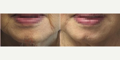Juvederm before and after photo