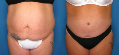 Tummy Tuck before and after photo