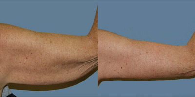 Arm Lift before and after photo