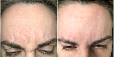 Botox before and after photo