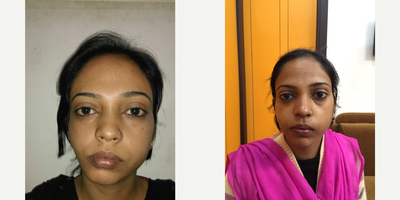 Facial Fat Transfer before and after photo
