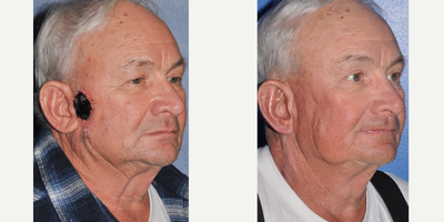 Facial Reconstructive Surgery before and after photo