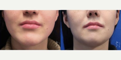 Facial Reconstructive Surgery before and after photo