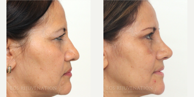 Brow Lift before and after photo