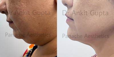 Chin Liposuction before and after photo