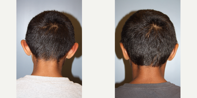 Ear Surgery before and after photo