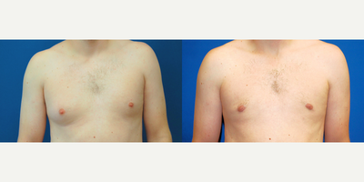 Gynecomastia Surgery before and after photo