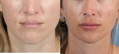 Lip Fillers before and after photo