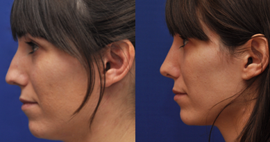 Rhinoplasty before and after photo