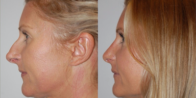Rhinoplasty before and after photo