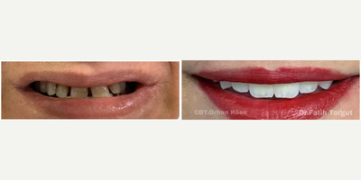 Smile Makeover before and after photo