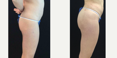 Brazilian Butt Lift before and after photo