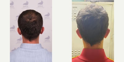 FUE Hair Transplant before and after photo