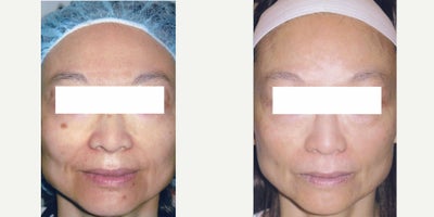 IPL before and after photo