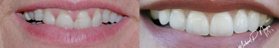 Porcelain Veneers before and after photo