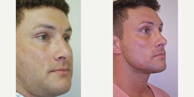 Rhinoplasty before and after photo