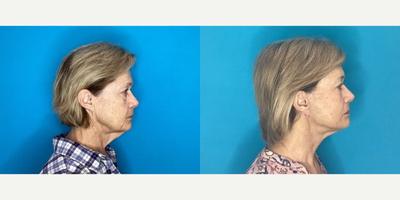 Eyelid Surgery before and after photo