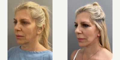 Eyelid Surgery before and after photo