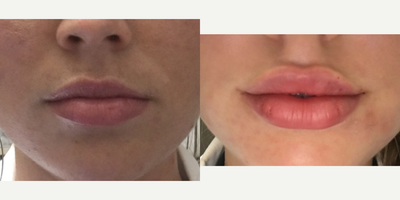 Lip Fillers before and after photo
