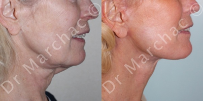 Neck Lift before and after photo