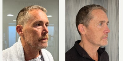 Revision Rhinoplasty before and after photo