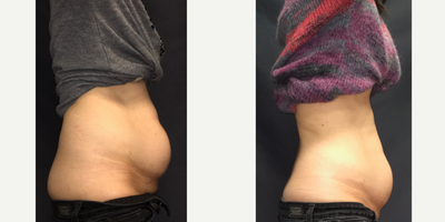 SculpSure before and after photo