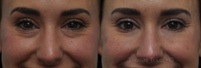 Botox before and after photo
