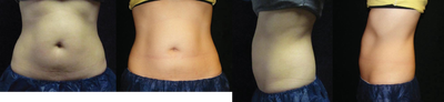 CoolSculpting before and after photo