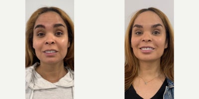 Dysport before and after photo