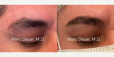 Eyebrow Transplant before and after photo