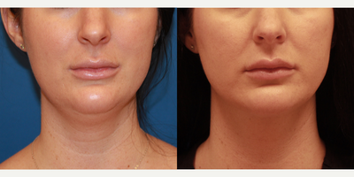 Liposuction before and after photo