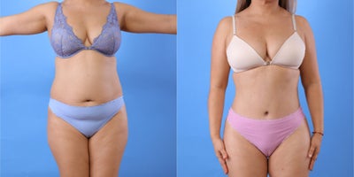 Mommy Makeover before and after photo