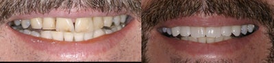Porcelain Veneers before and after photo