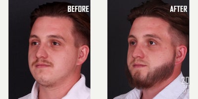 Beard Transplant before and after photo