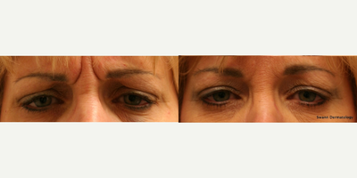 Botox before and after photo