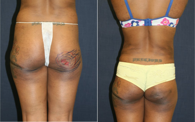 Brazilian Butt Lift before and after photo