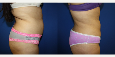 Liposuction before and after photo