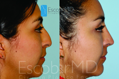Rhinoplasty before and after photo