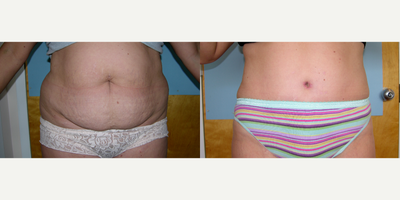 Tummy Tuck before and after photo