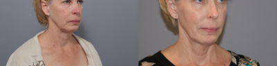ActiveFX before and after photo