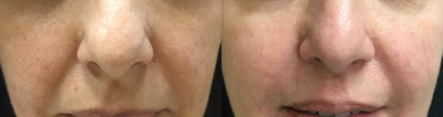Clear and Brilliant before and after photo
