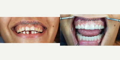 Dental Crown before and after photo
